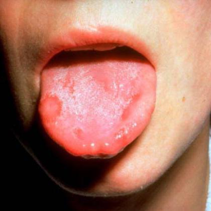 bolan jezik kod djece
