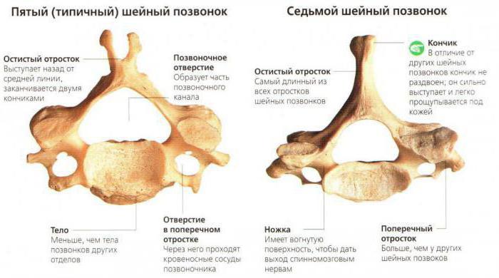 6 vertebra cervicale