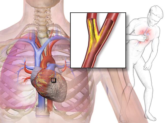 Liječenje koronarne srčane bolesti s hipertenzijom