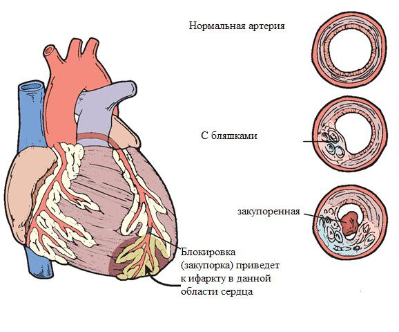 znaki angine in ishemije