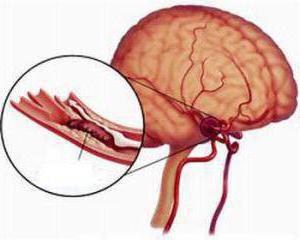 angioencefalopatia del cervello negli adulti