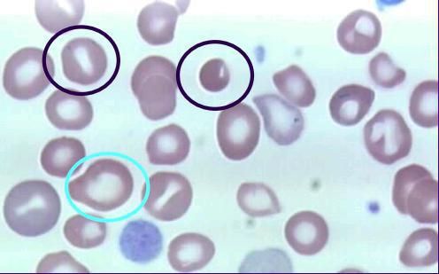 anizocitoza v splošnem krvnem testu