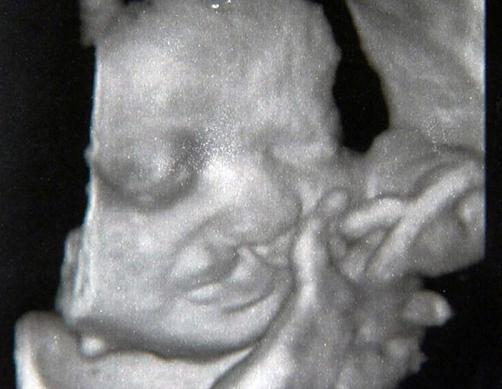 Těhotenské úmrtí plodu