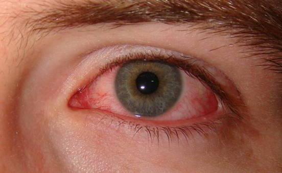 противовъзпалителни капки за очи