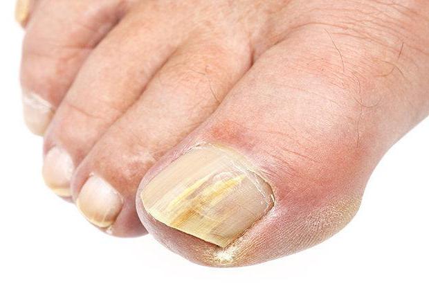 преглед на лак за нокти срещу гъбички на ноктите