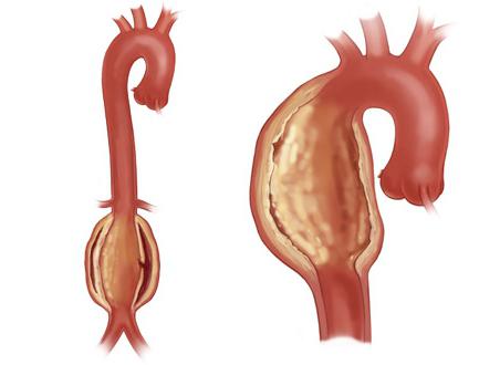 aortální ateroskleróza