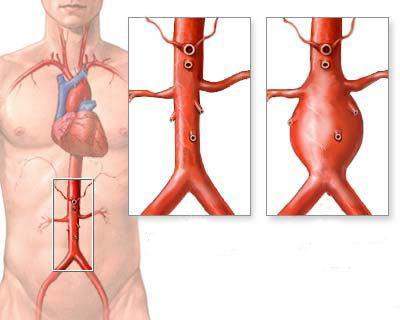 ateroskleroze liječenja abdominalne aorte