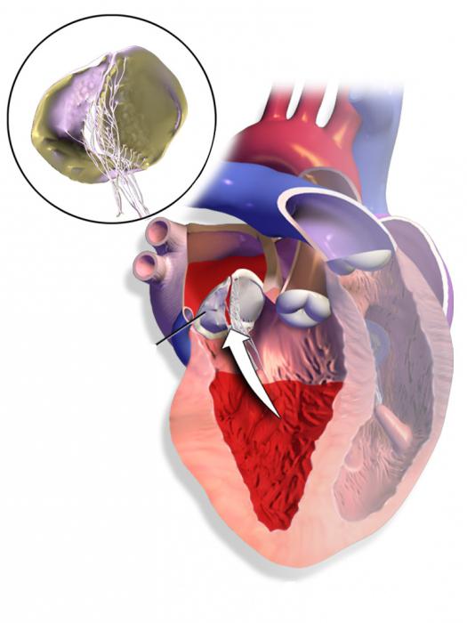 stopień zwężenia aorty