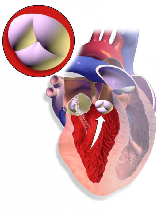 stenoza aorte
