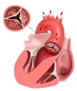 difetto aortico con predominanza di stenosi