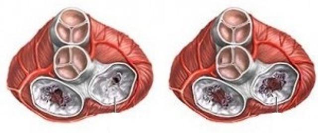 aortální stenóza