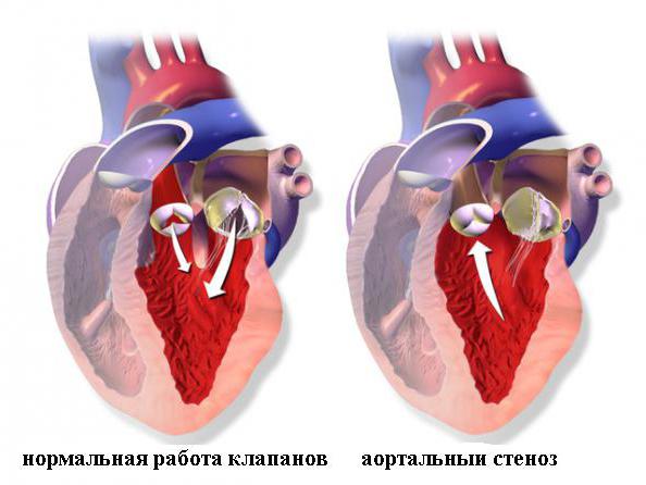 Zwężenie zastawki aortalnej