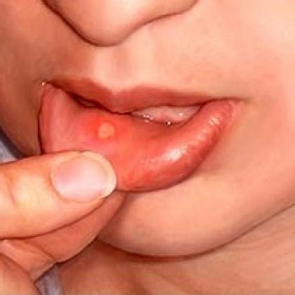 zdravljenje razjed v ustih