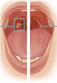 istruzione tonsillare