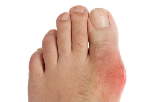 liječenje artritisa stopala