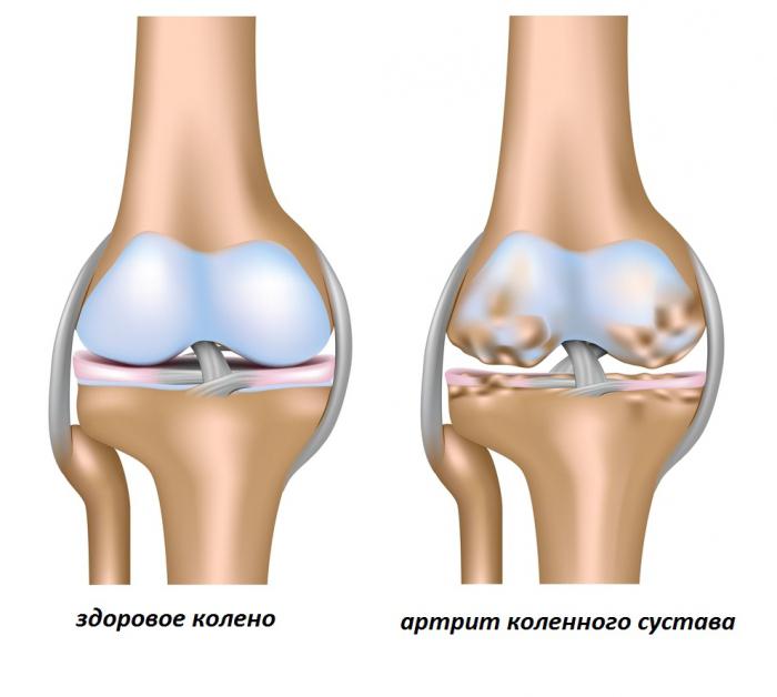 mast za bol u artritisu zgloba koljena)
