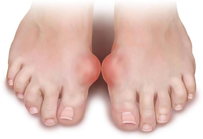 artritis artroza liječenje velikih nožnih prstiju)