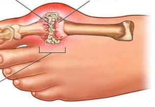 sintomi di artrite infettiva
