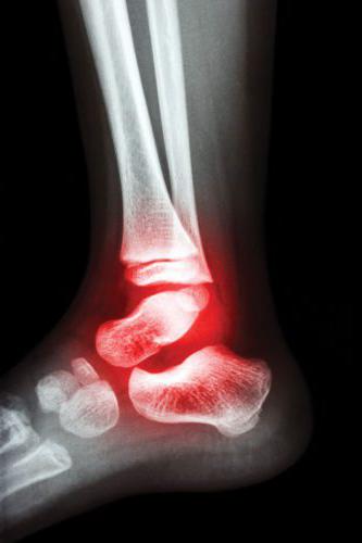 Artroza skočnog zgloba: simptomi i liječenje lijekovima i narodnim lijekovima