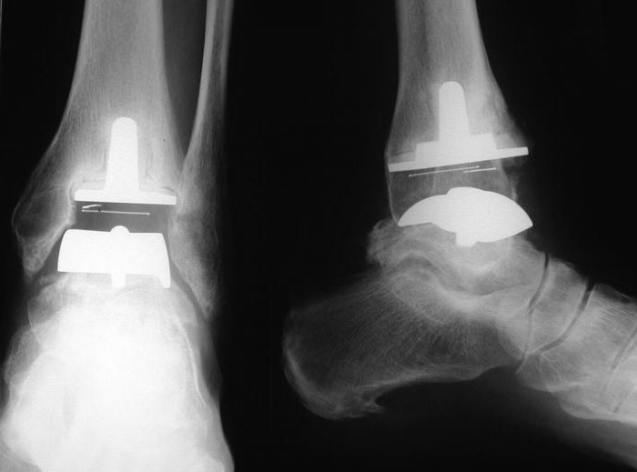 subtalar liječenje artroza medicinsko liječenje artroze koljena
