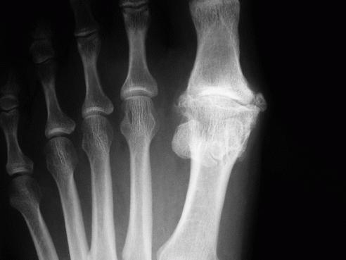 artroza o njezi stopala