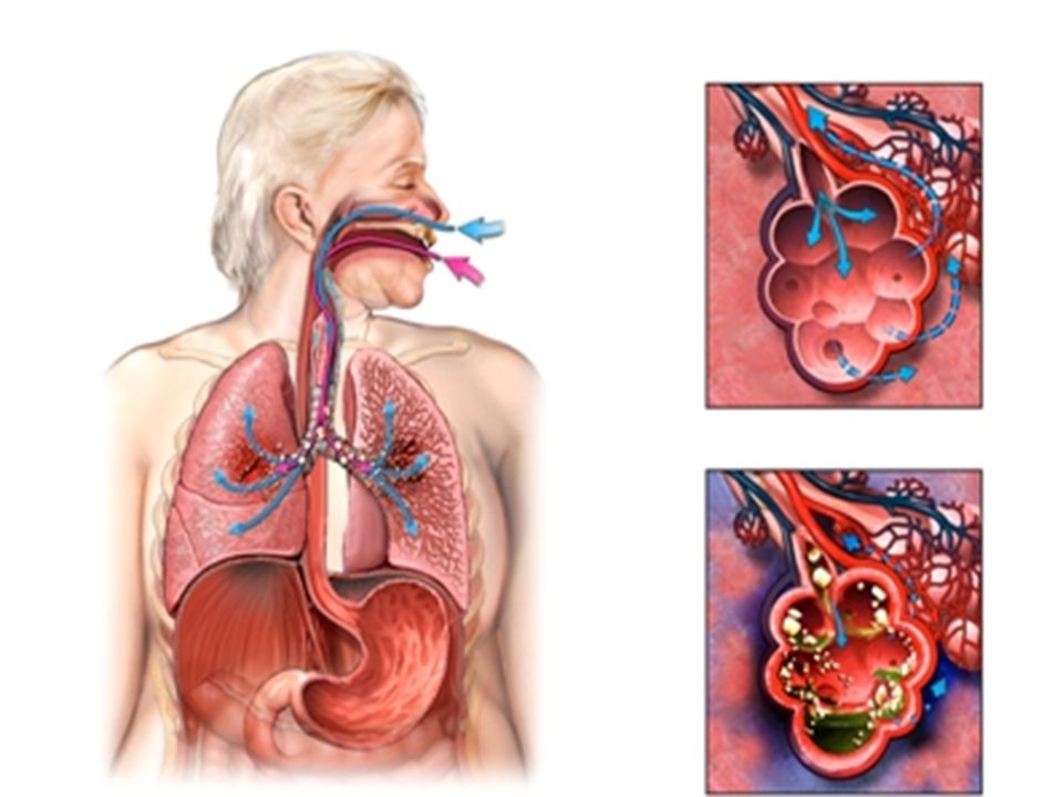 Il quadro clinico della polmonite da aspirazione