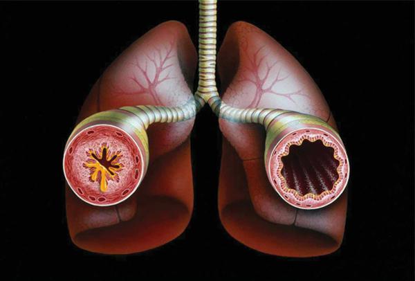 Známky astmatického stavu