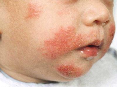 atopični dermatitis pri otrocih