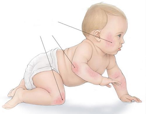 atopowe zapalenie skóry u niemowląt