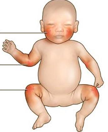 atopijski dermatitis u dojenčadi