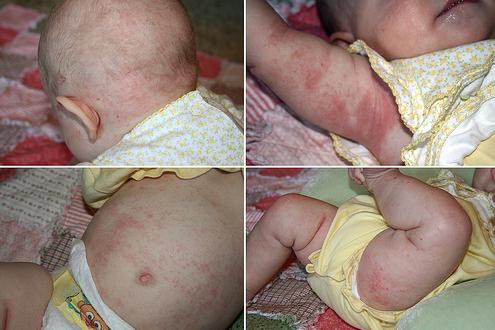 atopijski dermatitis kod simptoma dojenčadi