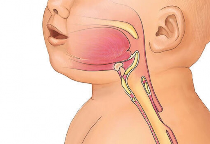 Атрезия на хранопровода при новородени