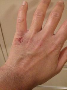 Avitaminosi: sintomi delle mani