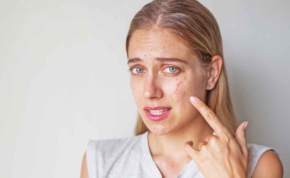 как азелаиновата киселина действа върху кожата