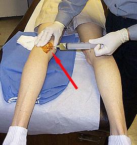 trattamento cisti del ginocchio baker