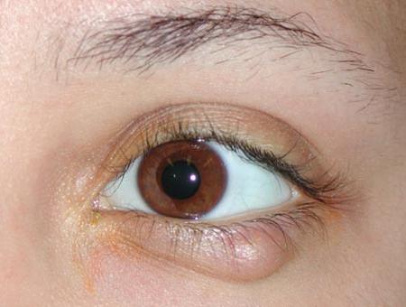 ечемично лечение на очите