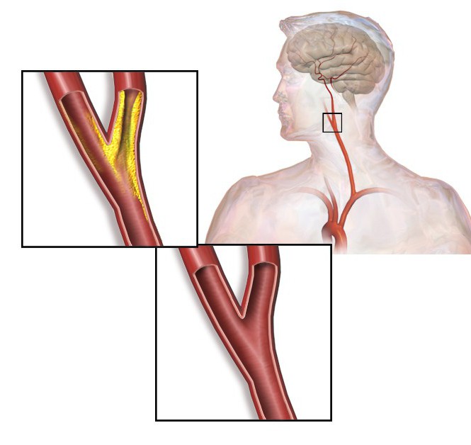 Linearna brzina protoka krvi u vertebralnim arterijama je normalna - Miokarditis February
