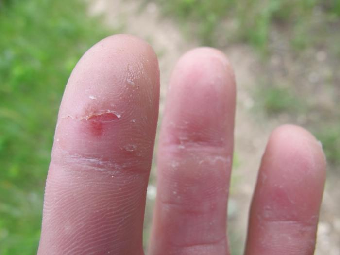кожа около пръстите