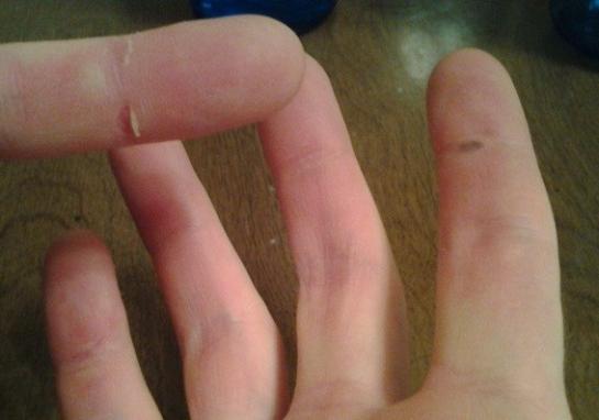 кожата на пръстите
