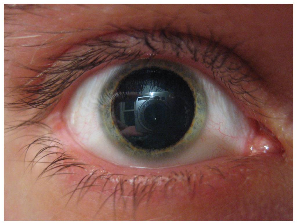 L'espansione della pupilla dovuta all'uso della belladonna.