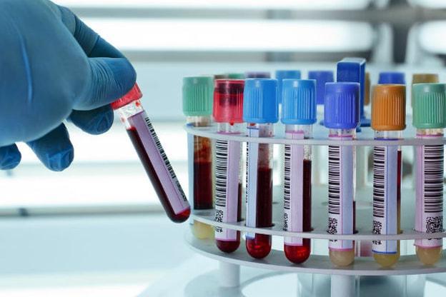 biochemická analýza bílkovin v krvi