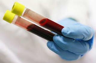 test del sangue biochimico mostrerà hiv