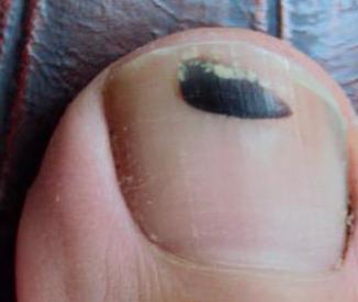 crni toenail