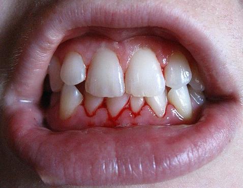 Лечение на кървене на венците