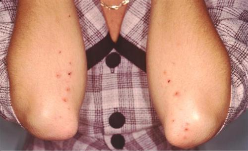 příznaky rakoviny kůže na kůži