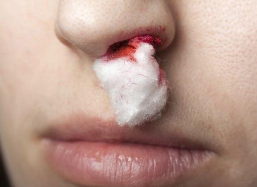 причините за кървене от носа