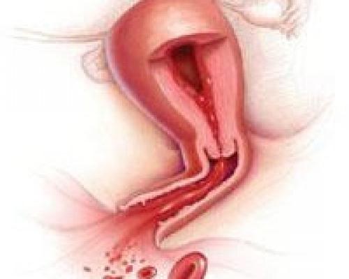 Vaginalna kri