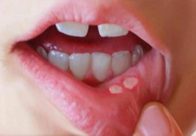 leczenie niebieskiego błony śluzowej jamy ustnej