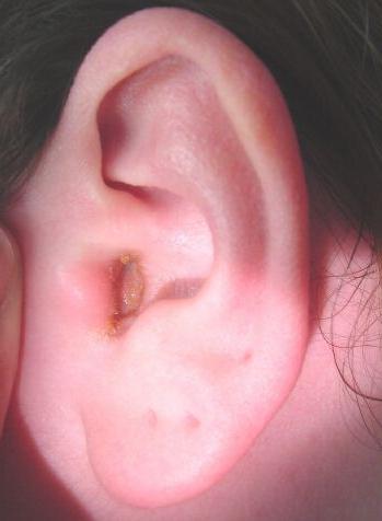 bollire nel trattamento dell'orecchio