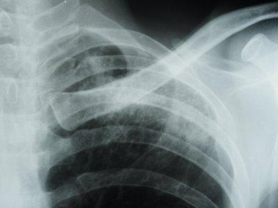 sintomi della tubercolosi ossea